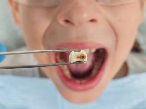Best Emergency Dental Care for Broken or Chipped Teeth in Mountainhome, PA